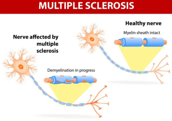 Figure 3: Multiple sclerosis: destruction of the myelin sheath  http://www.iflscience.com 