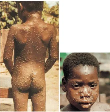 Figure 4: Enfant atteint de monkeypox (http: //www.who.int) 