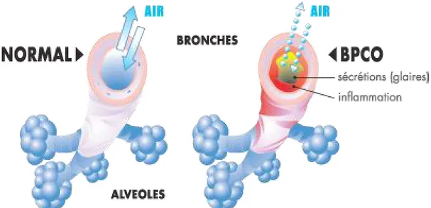 Figure 1 – Représentation des bronches d’un individu indemne de pathologie respiratoire (à  gauche) et d’un individu souffrant d’une BPCO (à droite) 