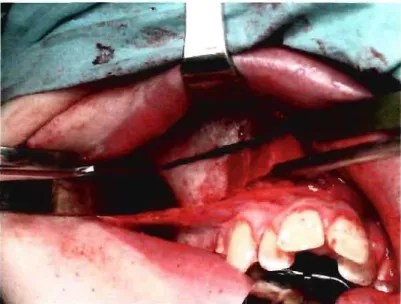 Figure 12  : Ostéotomie des murs latéraux nasaux et de l'apopbyse zygomatique  (Photo:  Dr Bilai  EI-Khatib) 