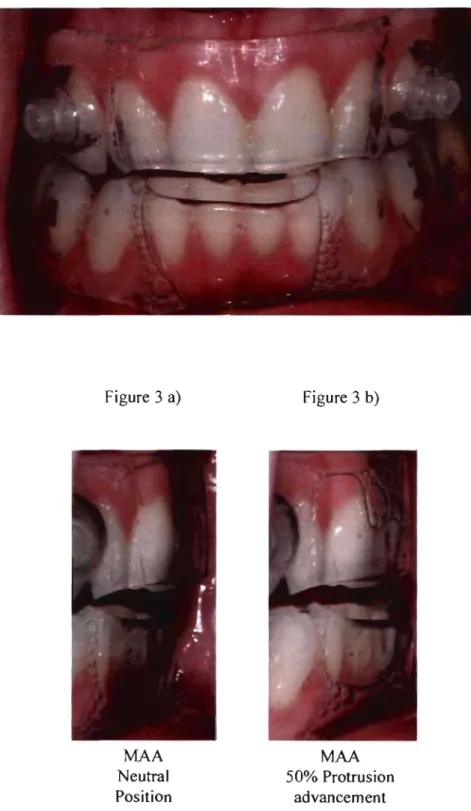 Figure  3  Figure  3 a)  MAA  Neutral  Position  Figure  3 b) MAA 50%  Protrusion advancement 