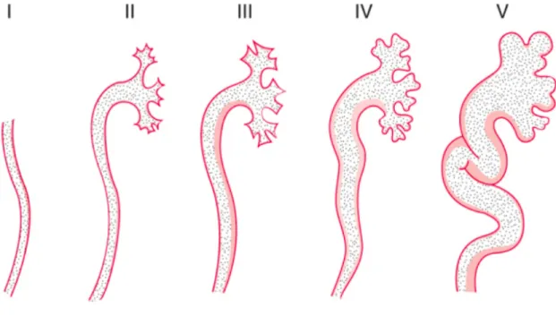 Figure 5. Schématisation des grades du reflux vésico-urétéro-rénal (10) 