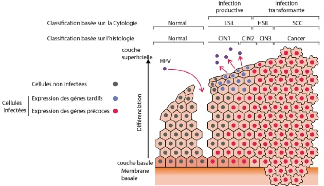 Figure 7. Lésions précancéreuses et cancéreuses induites par les HPV au niveau du col de l’utérus