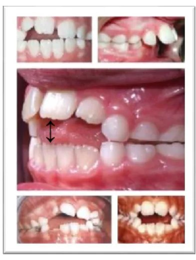 Figure 2: Malocclusion due to thumb and finger sucking. (Figure adapted from Google images) 