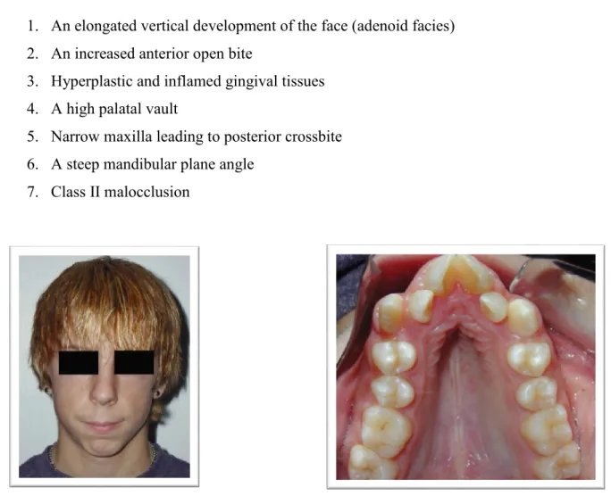 Figure  5  :  Patient  displaying  a  long  face  with  hyperactivity  of  the  mentalis  and  an  intraoral  photo of a high and narrow palatal vault associated with nasal airway obstruction
