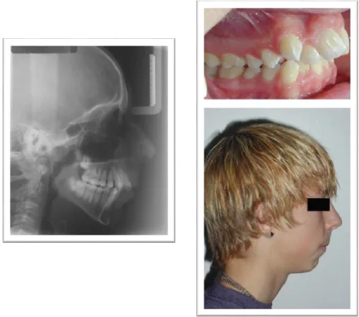 Figure  6  :  Lateral  cephalogram  displaying  an  increased  mandibular  plane  angle,  a  right  lateral intraoral photograph displaying a class II division 1 malocclusion, and a  lateral  extraoral  photograph  of  a  patient  with  a  retrusive  mandi