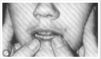 Figure 7 : Position of index fingers and thumbs during assessment of tongue  thrust. (Figure adapted from Weiss et al, 1972) 59