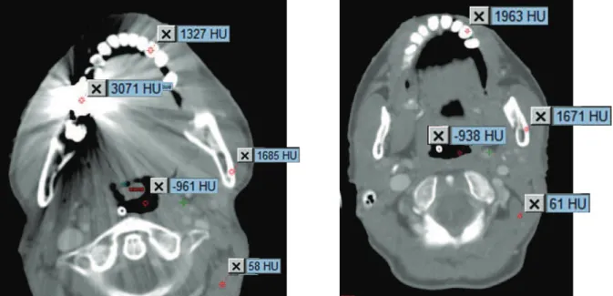 Figure 1.25 : Valeurs des UH sur une image CT avec des artéfacts métalliques dus à une prothèse dentaire (à gauche)  et sans artéfacts (à droite)