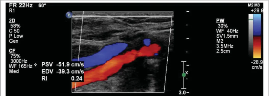 Figure 1.22 Artère carotidienne commune (en rouge) et veine jugulaire (en bleu) observées à l’aide du mode Doppler de