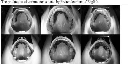 Figure  4  -  English  /d/  (damn),  /n/  (nap),  /t/  (tap)  from  left  to  right,  produced  by  an  advanced  learner (top) and a beginner (bottom)