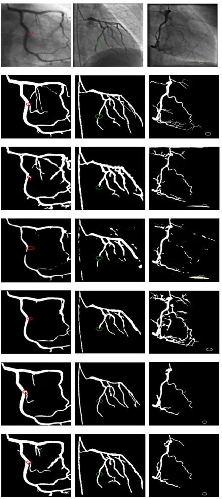 Figure 11: Segmentation results. Top to down: real angiograms ; ground truth ; hysteresis thresholding; fuzzy clustering; region growing; AQCA