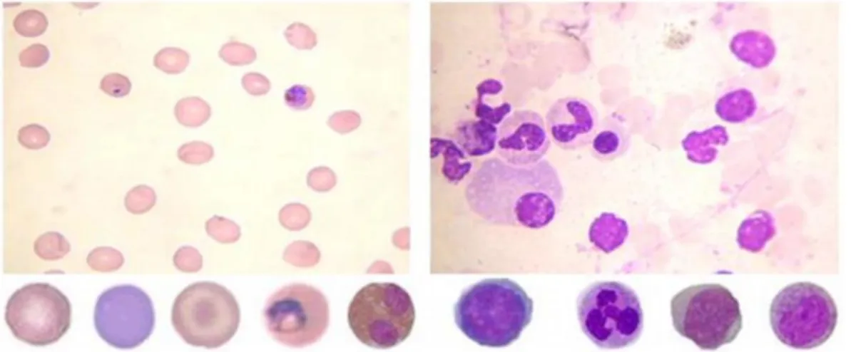 Figure 2 Peripheral blood and bone marrow smear samples. 