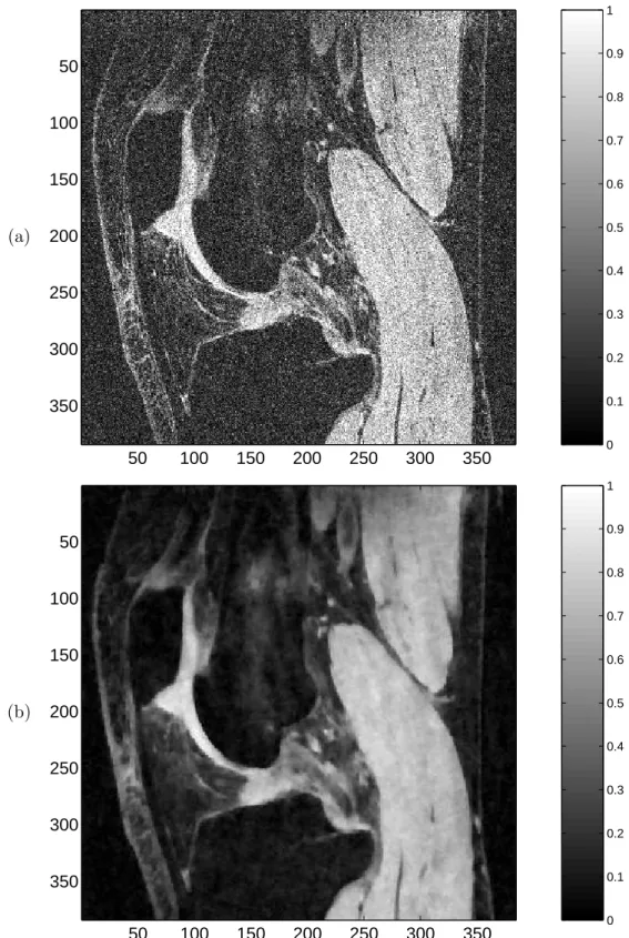 Fig. II.1: Restauration d’une image IRM de genou (GRBB, Ecole Polytechnique de Montr´eal).