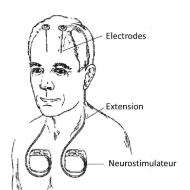 Figure 11: Représentation graphique du système utilisé pour une stimulation à haute fréquence