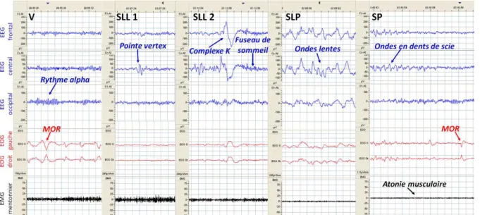 Figure  1  :  Tracés  électrophysiologiques  des  différents  états  de  vigilance  chez  l’être  humain,  avec  leurs  graphoéléments caractéristiques