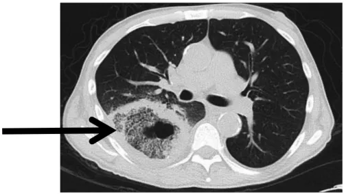 Figure  4  :  Signe  du  « halo  inversé »  (flèche  noire),  vue  axiale  sans  contraste  sur  une  image  de  tomodensitométrie, extraite de (51)