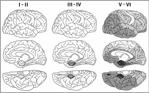 Figure 8 : Progression des DNFs dans le cerveau des patients Alzheimer  (Braak et Braak 1991)