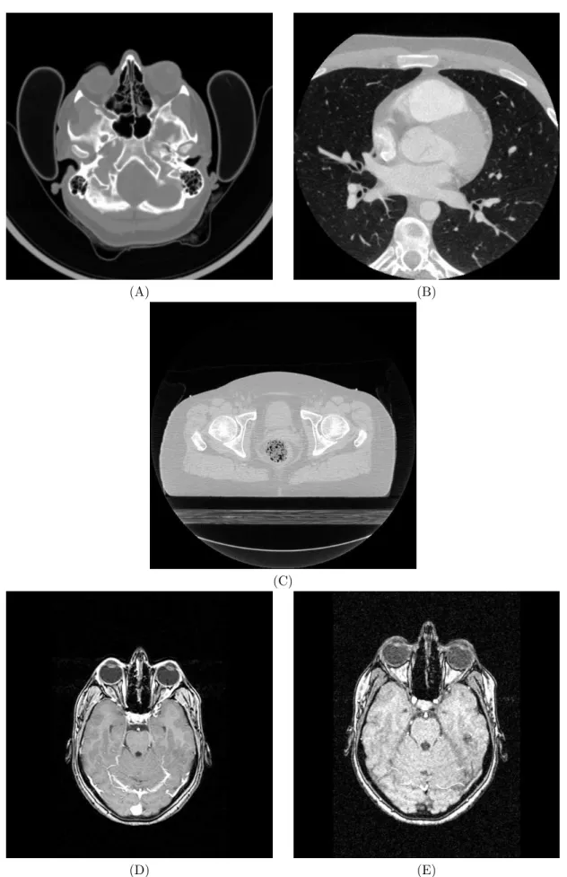 Fig. 6.8 – Exemples d’images de la s´election : (A) CT avec un bruit faible, (B) CT avec un bruit de reconstruction important mais diffus (filtrage), (C) CT avec un bruit tr`es marqu´e, (D) IRM et (E) IRM3D.