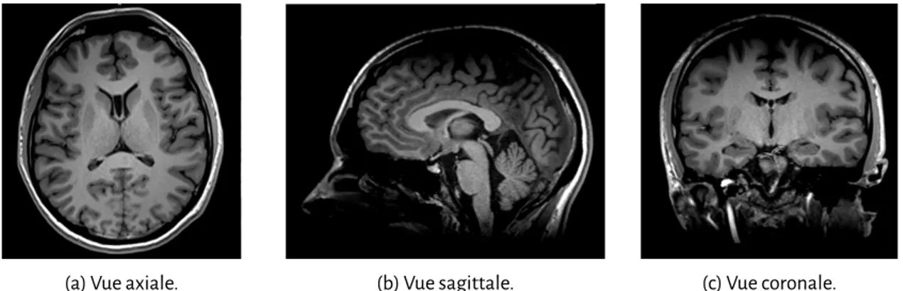 Figure 2.5 – Images issues de l’IRM grˆace `a une s´equence anatomique (Centre Hospitalier Universitaire (CHU) de Poitiers, tous droits r´eserv´es)