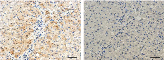 Figure 11. Accumulation d’IL-26 dans les hépatocytes infectés. Analyse de l’expression de l’IL-26 (en  marron) et de l’ADN (en bleu) par immunohistochimie