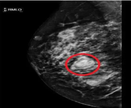 Figure III.4 Mammographie portant une tumeur maligne 
