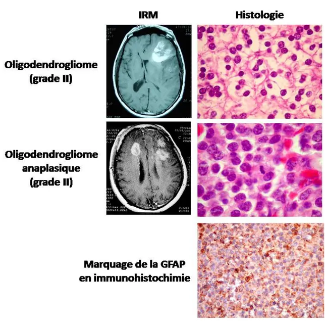 Figure 3 : Imagerie et histologie des tumeurs oligodendrocytaires (anatpat.unicamp.br)
