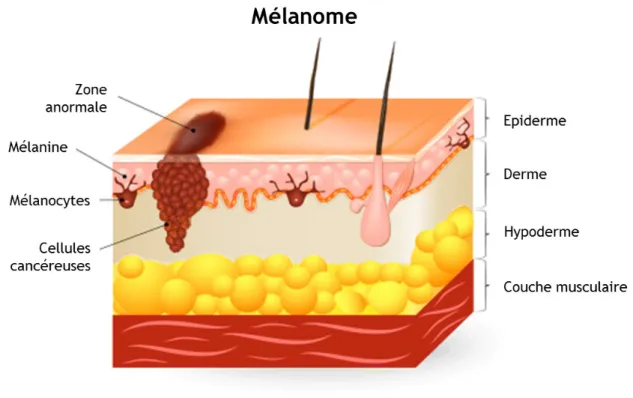 Figure 10 : Le mélanome (modifié d’après l’association colombienne de dermatologie). 