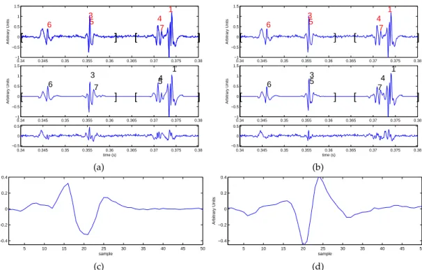 Fig. 2.8 – Comparaison des deux versions de décomposition par maximisation itérative. (a) en haut : deux segments d’un signal EMG enregistré sont affichés, chacun délimité par les crochets