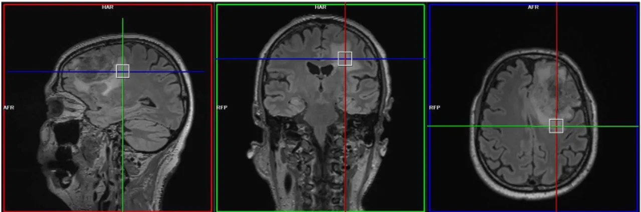 Figure 1.4 – Détermination de la zone d’étude. De gauche à droite : plan sagittal coronal et axial.