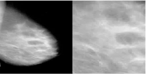 Figure 1.11 – Une mammographie à gauche et l’extraction d’une zone d’intérêt à droite.