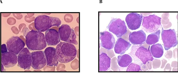 Figure 7: Frottis médullaires de patients atteints de LAP  