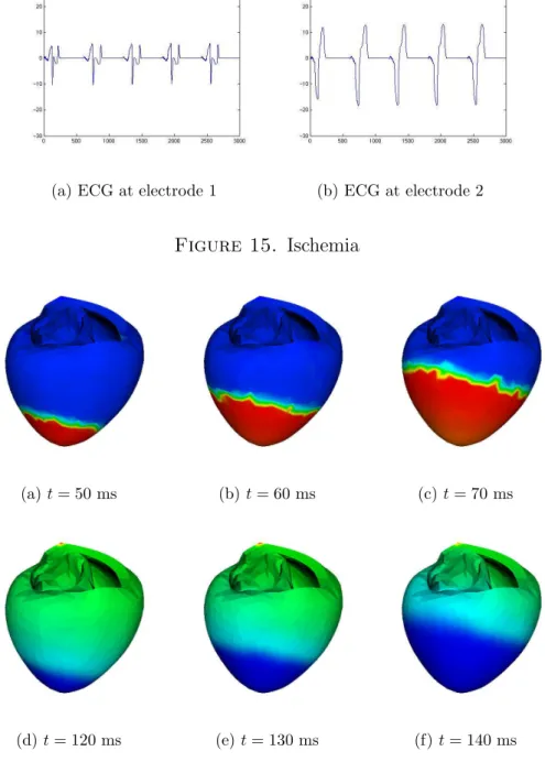 Figure 15. Ischemia