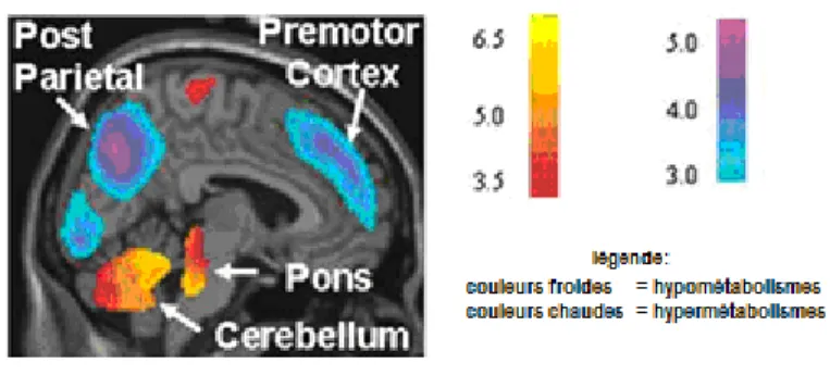Figure 1. Profil d’activation cérébrale dans la MP sans démence (« PDRP »)  [Adaptée de Ma et al., 2007] 