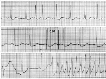 Figure  1.6:  Exemples  d’enregistrement  d’ECG  d’un  patient  qui  avait  récemment  commencé  à  recevoir  le  sotalol  (médicament  associé  à  un  risque  élevé  de  TdP)