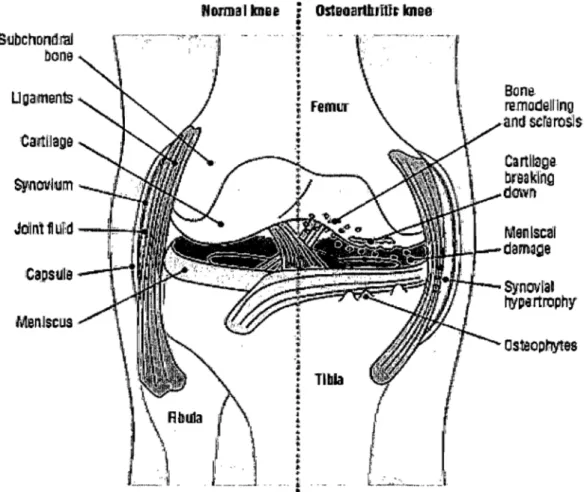 Figure  2 :  Différence  entre  un  genou  normal  et  un  genou  DA.  La  figure  montre  les  changements dans les différents tissus tels que  la formation d'ostéophytes, la dégradation  du  cartilage,  les  dommages  au  ménisque,  le  remodelage  et  l