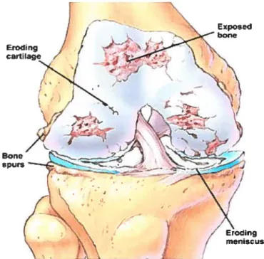 Figure 2 t Description des caractéristiques de l’articulation arthrosique du genou