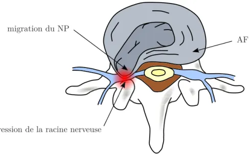 Figure 1.12 – Phénomène de hernie discale avec migration du NP à l’extérieur de son emplacement et compression du nerf sciatique.