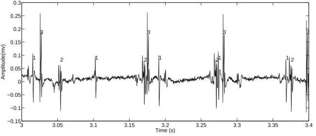 Figure 2.5 – Example of iEMG signal was acquired using 25G wire electrodes (A-M Systems, Carlsborg, WA, USA) made of Teflon coated stainless steel with a diameter of 0.05 mm