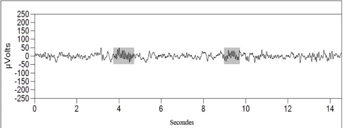 Figure 4. Fuseaux de sommeil chez l’être humain. 