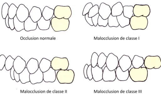 Figure   1   :   Occlusion   normale   et   les   classes   de   malocclusions   décrites   par   Angle