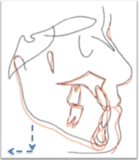 Figure   9   :   Rotation   mandibulaire   typique   suite    à   un   traitement   avec   un   appareil   chin   cup
