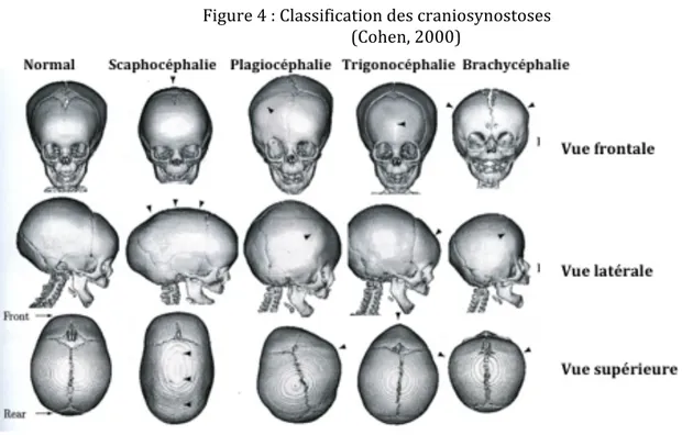 Figure   4   :   Classification   des   craniosynostoses    (Cohen,   2000)                                       