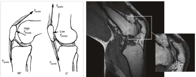 Figure 11 Illustration schématique du syndrome fémoro- patellaire d’après  Callaghan, (2005) à droite : F quads