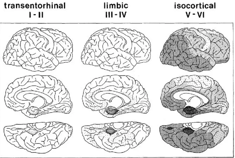 Figure 10 : Les six stades de propagation des DNF de Braak et Braak. 