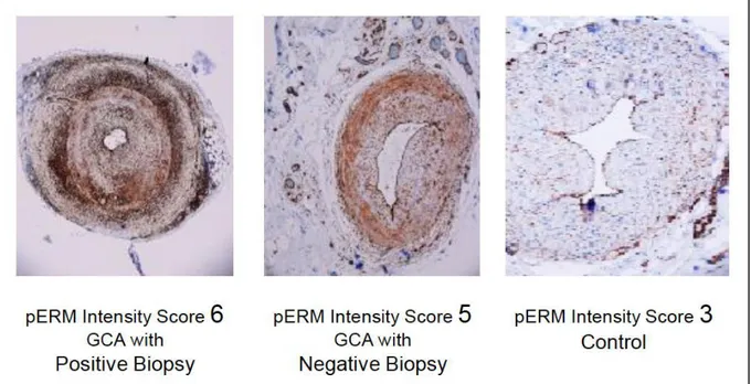 Figure 2 : M arquage de pERM sur des BAT de patients affectés d’ACG à BAT positive, négative  ou de sujets contrôles