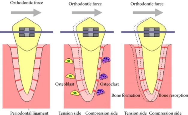 Figure  1  :  Schématisation  de  la  compression-tension  lors  de  l’application  d’une  force  orthodontique  14