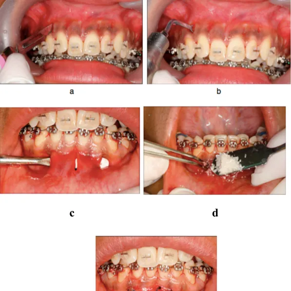 Figure 4 : a) Incisions muqueuses b) utilisation du piézotome  TM  c) tunnélisation, d) greffe  allogène et e) sutures  52