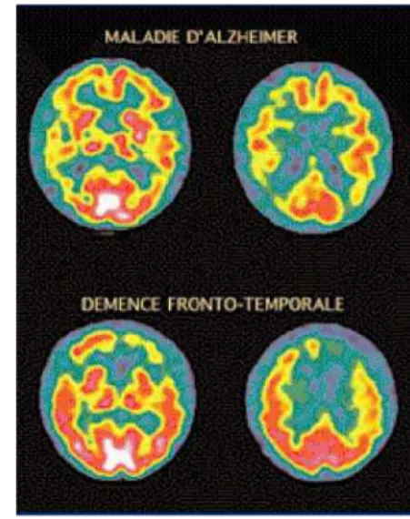 Figure 5 : Comparaison des PET-scans d’un patient souffrant d’une démence  frontotemporale et d’un patient atteint de la maladie d’Alzheimer  