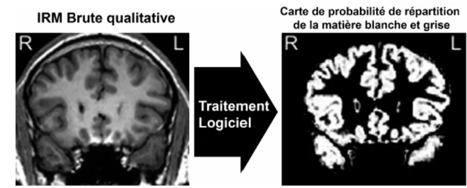 Figure 11 : Illustration d’un traitement d’une IRM brute quantitative 