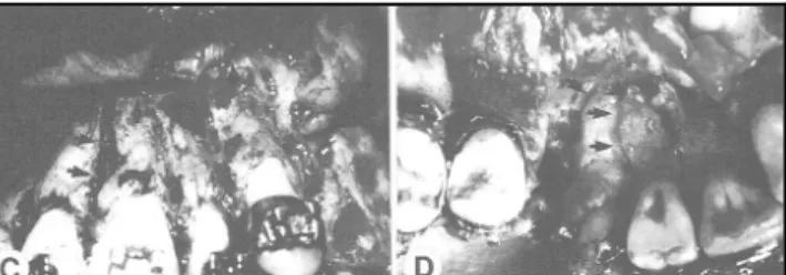 Figure 5.  Photo intra-orale de la technique chirurgicale de Gantes et al. (61) 